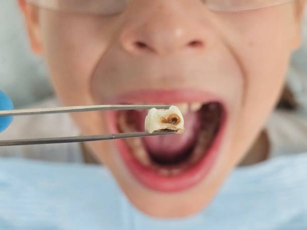Best Emergency Root Canal Treatment in Ashton Sandy Spring, MD